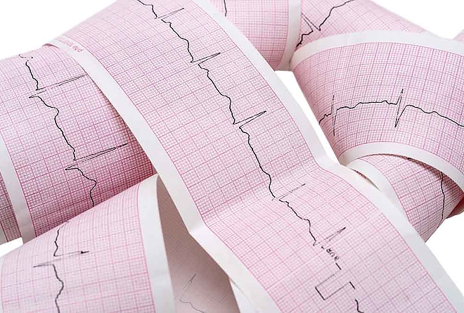 ekg_sziv_szivritmuszavar.jpg