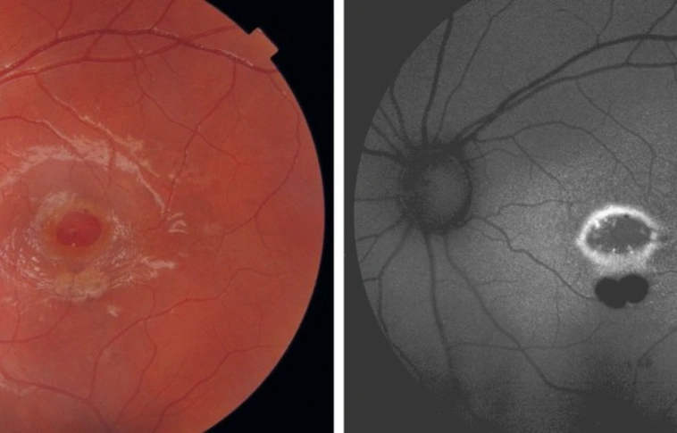 Szörnyű vége lett a játéknak: lyukat égetett a saját szemébe a kisfiú